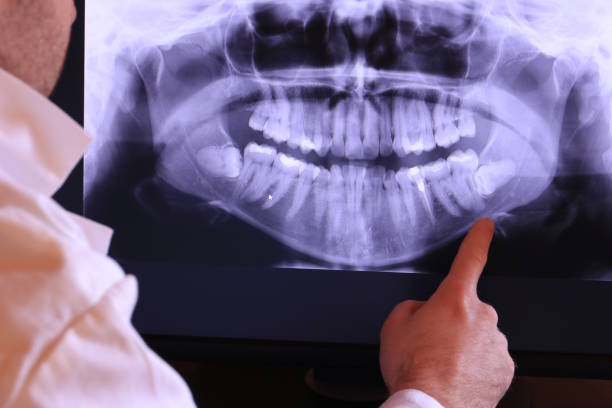 Best Emergency Wisdom Teeth Removal in Keuka Park, NY
